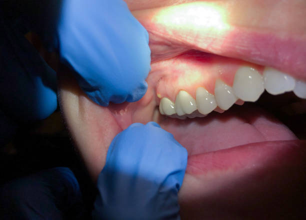 Best Emergency Dental Care for Abscessed Tooth in Crestwood, MO